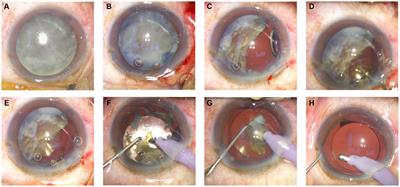 Observations of the efficacy of the artificial lens cushion plate technique in hard-core cataract surgery